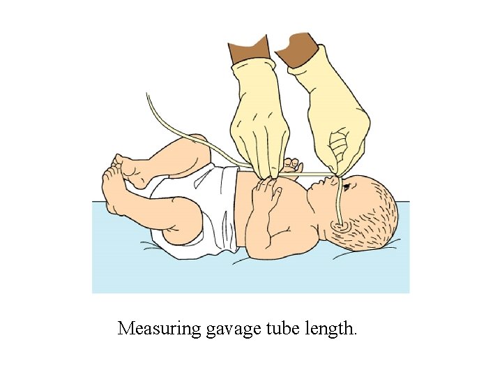 Measuring gavage tube length. 