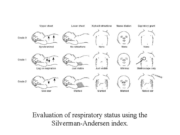 Evaluation of respiratory status using the Silverman-Andersen index. 