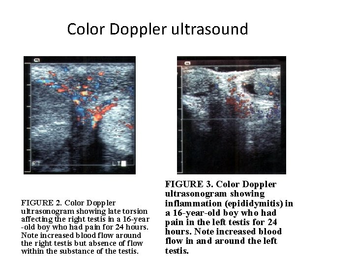 Color Doppler ultrasound FIGURE 2. Color Doppler ultrasonogram showing late torsion affecting the right