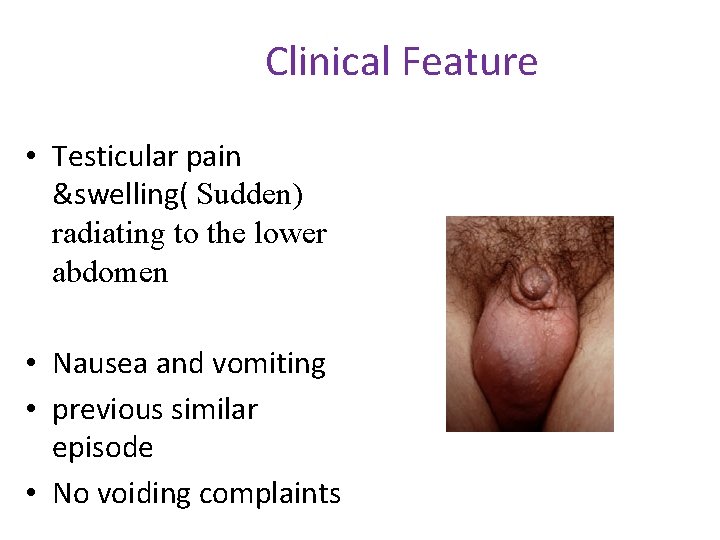 Clinical Feature • Testicular pain &swelling( Sudden) radiating to the lower abdomen • Nausea