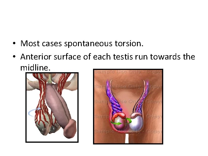  • Most cases spontaneous torsion. • Anterior surface of each testis run towards