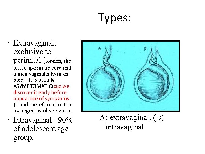 Types: Extravaginal: exclusive to perinatal (torsion, the testis, spermatic cord and tunica vaginalis twist