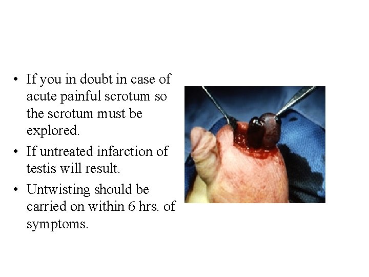  • If you in doubt in case of acute painful scrotum so the