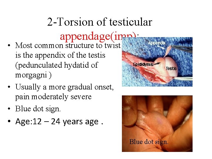 2 -Torsion of testicular appendage(imp): • Most common structure to twist is the appendix