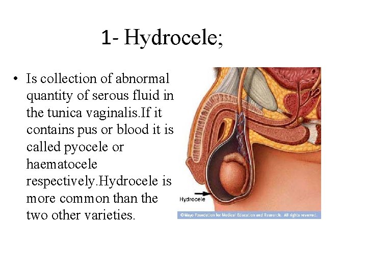 1 - Hydrocele; • Is collection of abnormal quantity of serous fluid in the