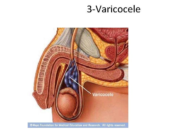 3 -Varicocele 