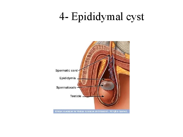 4 - Epididymal cyst 