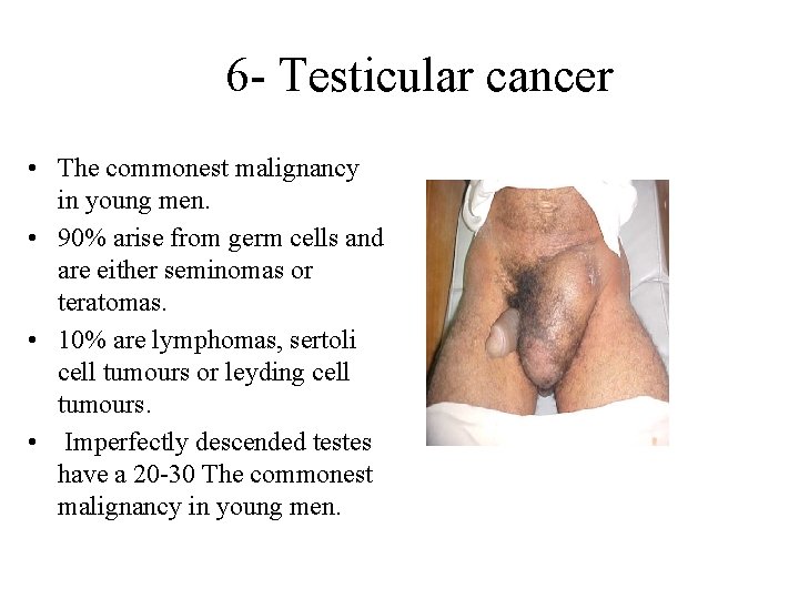 6 - Testicular cancer • The commonest malignancy in young men. • 90% arise