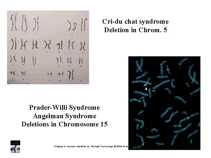 Cri-du chat syndrome Deletion in Chrom. 5 Prader-Willi Syndrome Angelman Syndrome Deletions in Chromosome