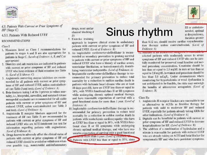 Sinus rhythm 