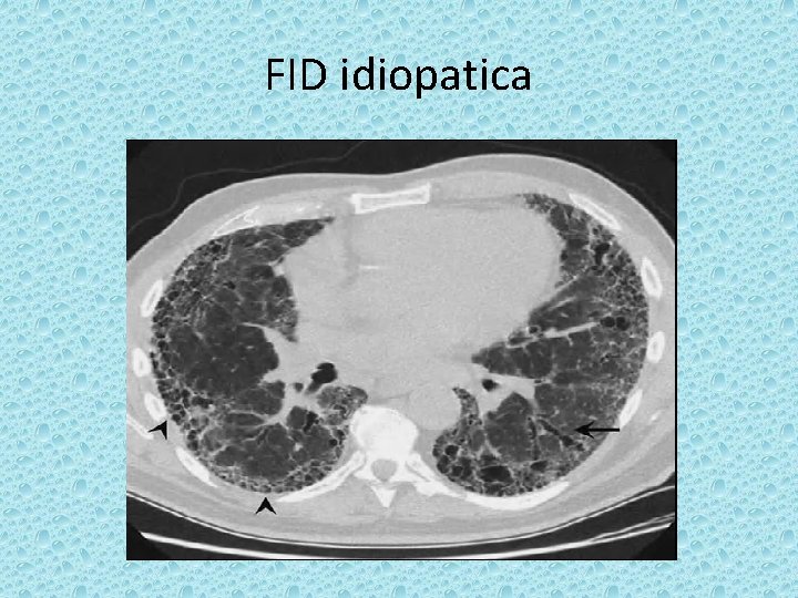 FID idiopatica 