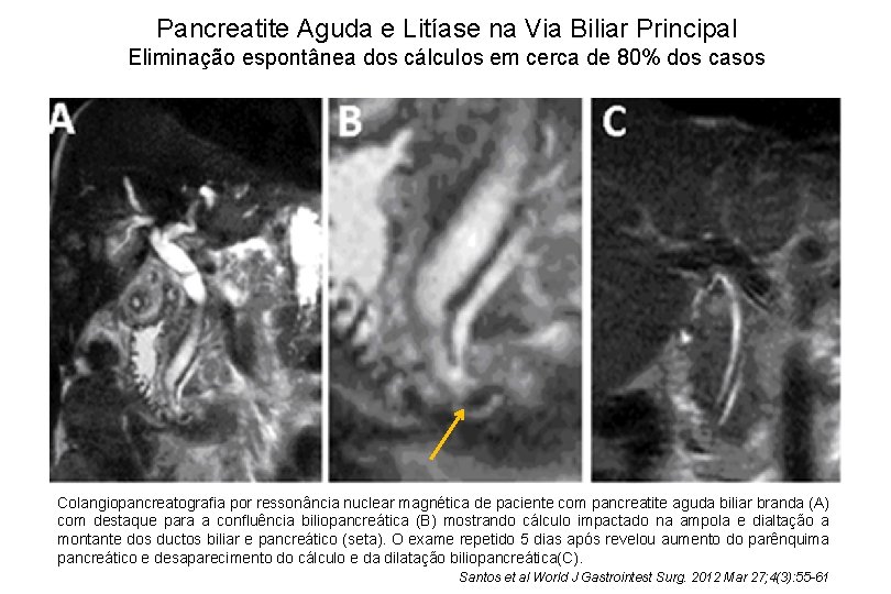 Pancreatite Aguda e Litíase na Via Biliar Principal Eliminação espontânea dos cálculos em cerca