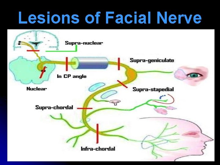 Lesions of Facial Nerve 