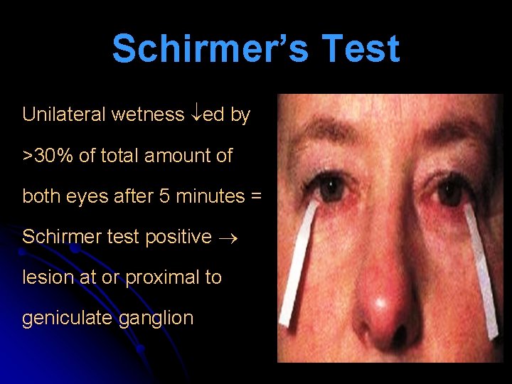 Schirmer’s Test Unilateral wetness ed by >30% of total amount of both eyes after