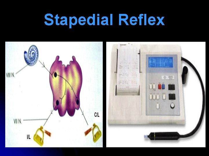 Stapedial Reflex 