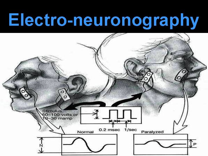 Electro-neuronography 