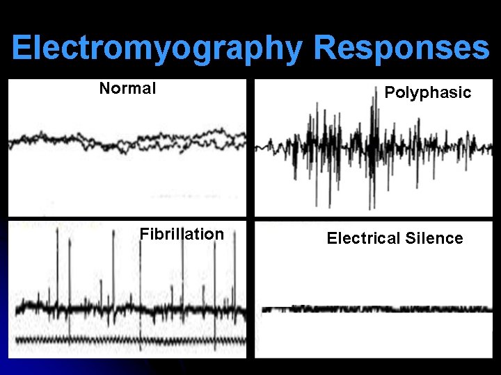 Electromyography Responses Normal Fibrillation Polyphasic Electrical Silence 