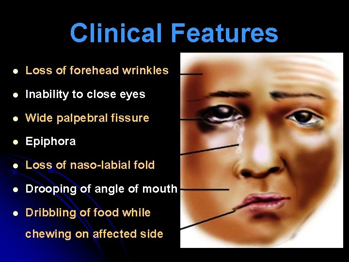 Clinical Features l Loss of forehead wrinkles l Inability to close eyes l Wide