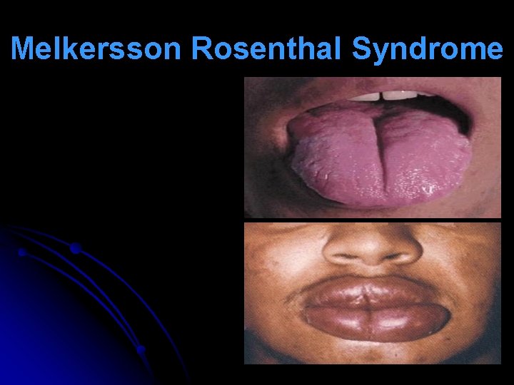 Melkersson Rosenthal Syndrome 