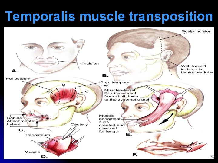 Temporalis muscle transposition 