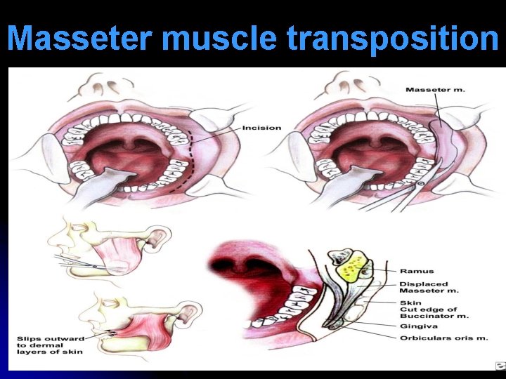 Masseter muscle transposition 