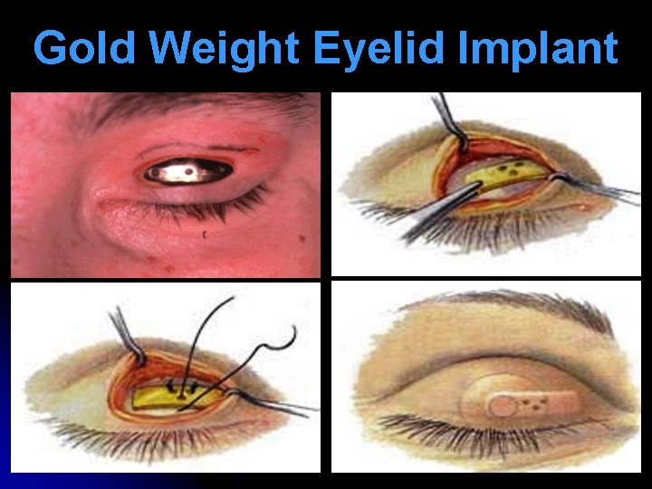 Gold Weight Eyelid Implant 