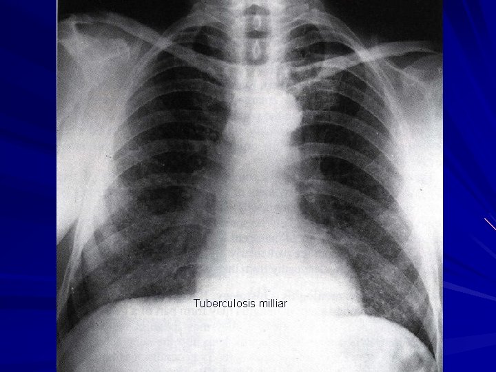 Tuberculosis milliar 