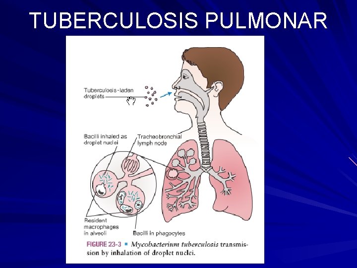 TUBERCULOSIS PULMONAR 