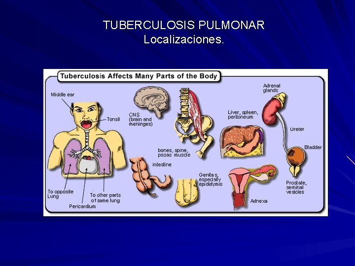 TUBERCULOSIS PULMONAR Localizaciones. 