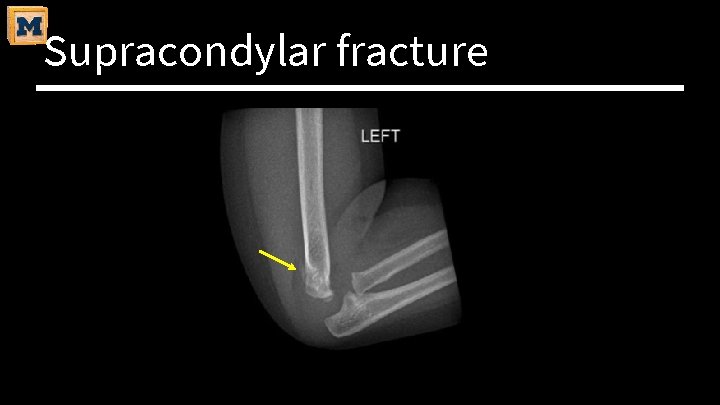 Supracondylar fracture 