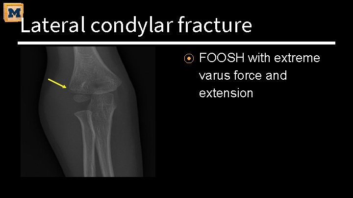 Lateral condylar fracture ⦿ FOOSH with extreme varus force and extension 