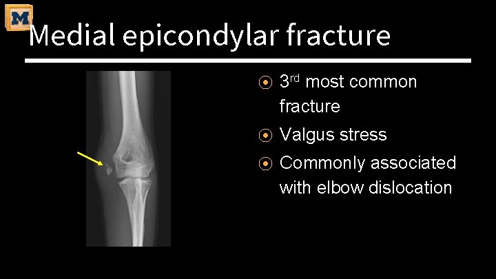 Medial epicondylar fracture ⦿ 3 rd most common fracture ⦿ Valgus stress ⦿ Commonly