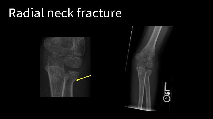 Radial neck fracture 