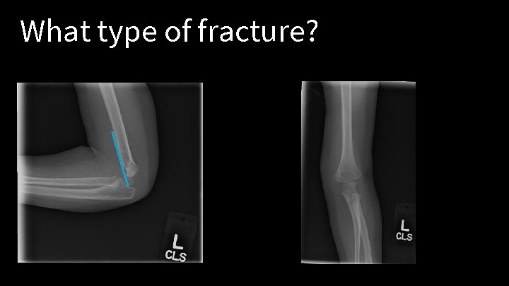 What type of fracture? 