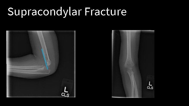 Supracondylar Fracture 