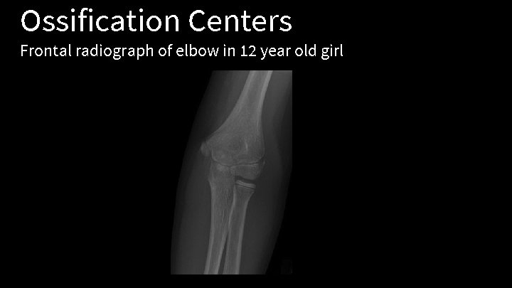 Ossification Centers Frontal radiograph of elbow in 12 year old girl 