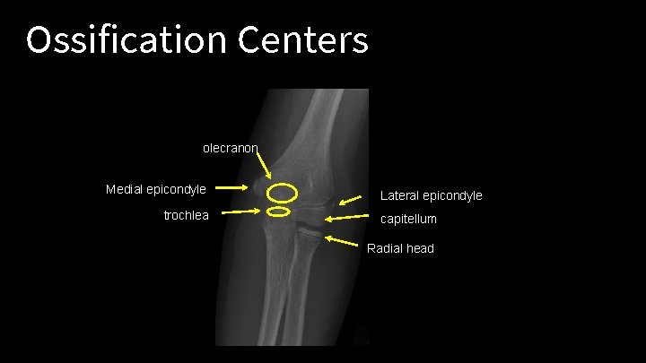 Ossification Centers olecranon Medial epicondyle trochlea Lateral epicondyle capitellum Radial head 