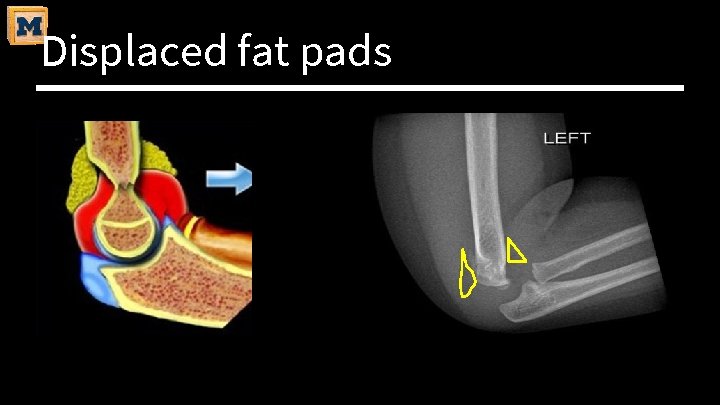Displaced fat pads 