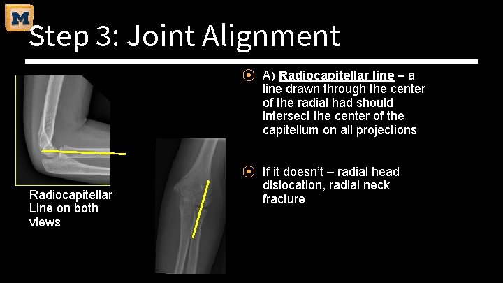 Step 3: Joint Alignment ⦿ A) Radiocapitellar line – a line drawn through the