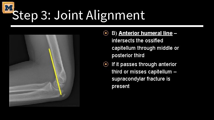 Step 3: Joint Alignment ⦿ B) Anterior humeral line – intersects the ossified capitellum