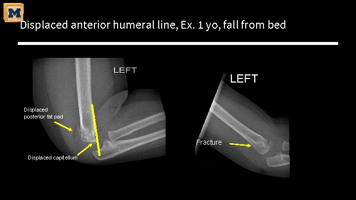 Displaced anterior humeral line, Ex. 1 yo, fall from bed Displaced posterior fat pad