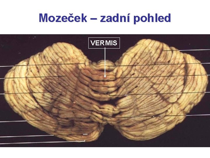 Mozeček – zadní pohled VERMIS 