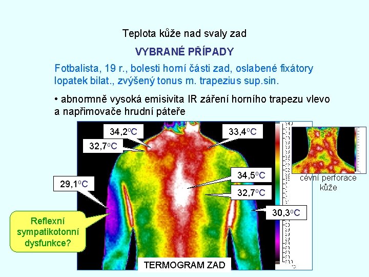 Teplota kůže nad svaly zad VYBRANÉ PŘÍPADY Fotbalista, 19 r. , bolesti horní části
