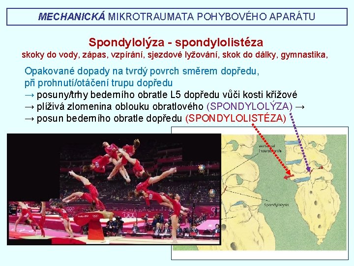 MECHANICKÁ MIKROTRAUMATA POHYBOVÉHO APARÁTU Spondylolýza - spondylolistéza skoky do vody, zápas, vzpírání, sjezdové lyžování,