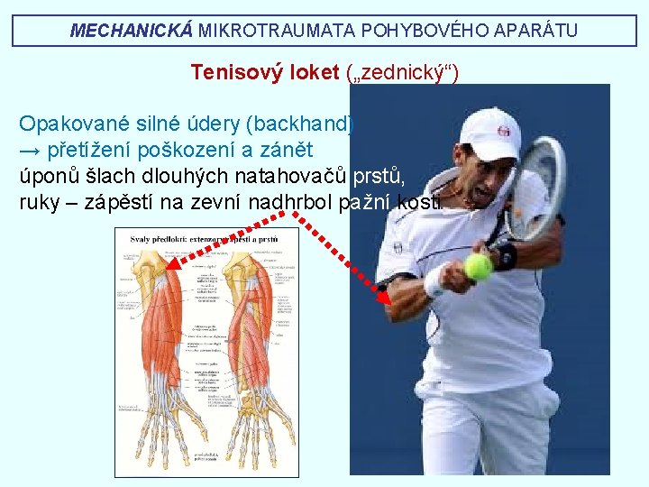 MECHANICKÁ MIKROTRAUMATA POHYBOVÉHO APARÁTU Tenisový loket („zednický“) Opakované silné údery (backhand) → přetížení poškození