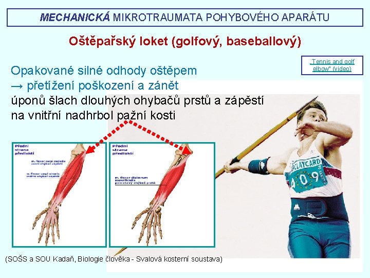 MECHANICKÁ MIKROTRAUMATA POHYBOVÉHO APARÁTU Oštěpařský loket (golfový, baseballový) Opakované silné odhody oštěpem → přetížení