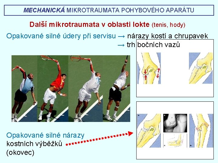 MECHANICKÁ MIKROTRAUMATA POHYBOVÉHO APARÁTU Další mikrotraumata v oblasti lokte (tenis, hody) Opakované silné údery