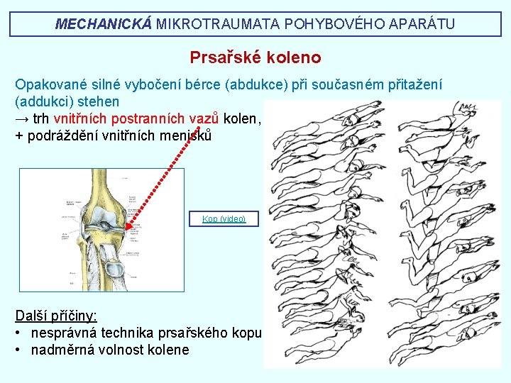 MECHANICKÁ MIKROTRAUMATA POHYBOVÉHO APARÁTU Prsařské koleno Opakované silné vybočení bérce (abdukce) při současném přitažení