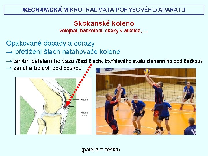 MECHANICKÁ MIKROTRAUMATA POHYBOVÉHO APARÁTU Skokanské koleno volejbal, basketbal, skoky v atletice, … Opakované dopady