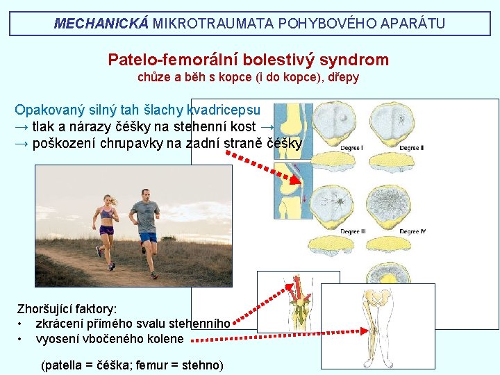 MECHANICKÁ MIKROTRAUMATA POHYBOVÉHO APARÁTU Patelo-femorální bolestivý syndrom chůze a běh s kopce (i do